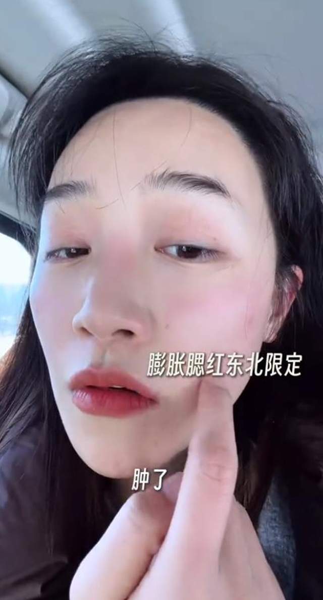 原創藍盈瑩吉林遊玩，零下24度戶外只待半個小時就被凍傷，臉又紅又腫