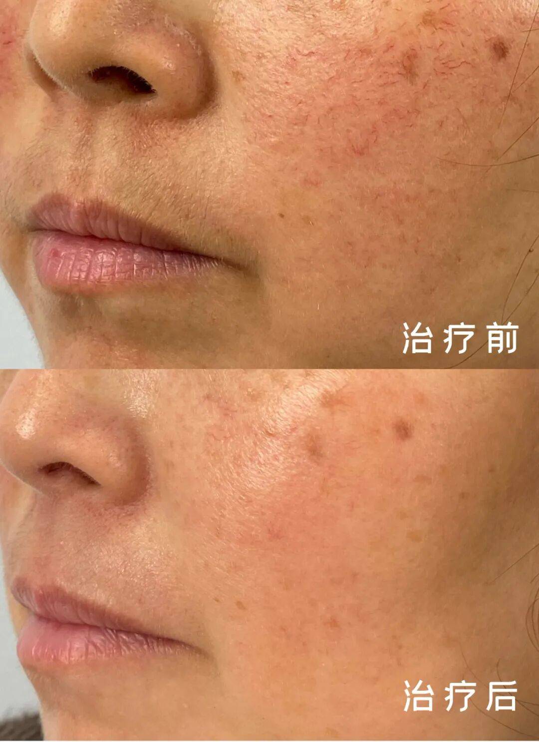 美麗的誤會：當“玫瑰”不是花，而是玫瑰痤瘡