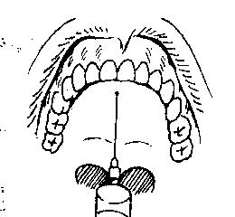 牙科必懂的口腔區域性麻醉