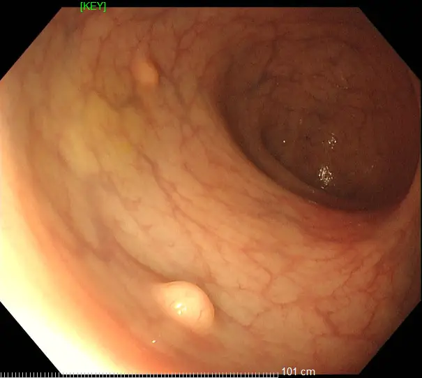 發現早期腸道腫瘤，胃腸鏡檢查很有必要