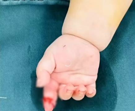 女子抱娃拆快遞剪斷嬰兒手指